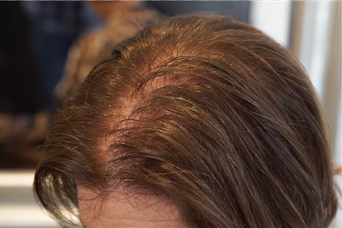 Putimi Anti-Hair Loss - Hair Growth - Image 4